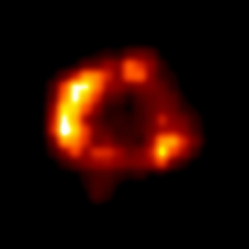 Xray of Sn1987a